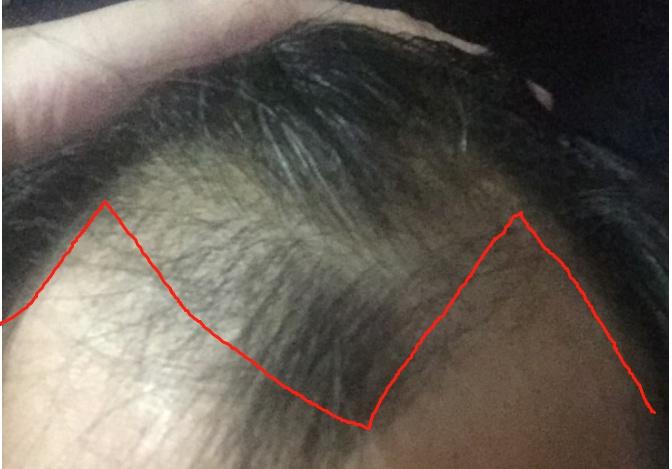 植发的危害和后遗症有哪些?植发有什么注意事项?