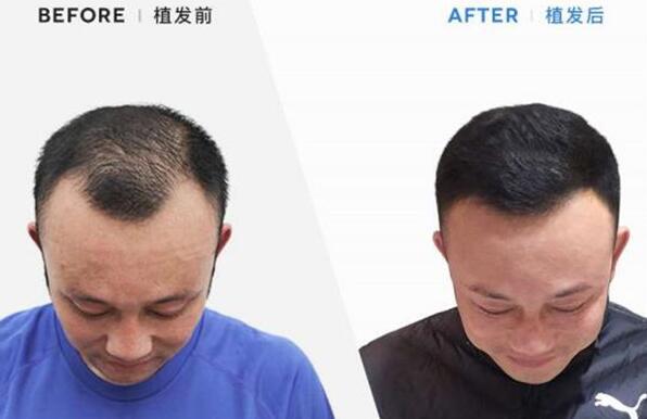 是植发好还是织发 两种方法各有利弊