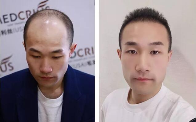 是植发好还是织发