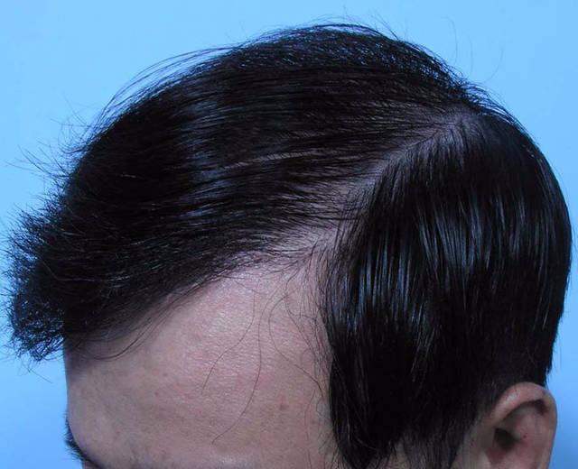 脱发怎么办 常呵护比植发更有用