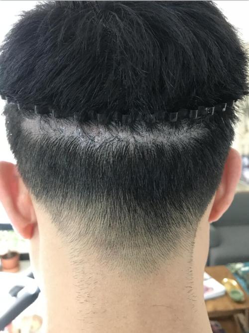 植发的危害很大 ,都有哪些,植发后要注意什么