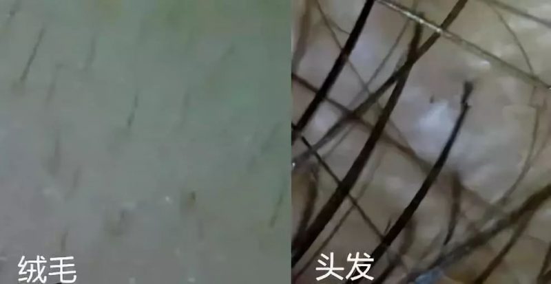 生发产品有用吗？脱发要怎么办呢？