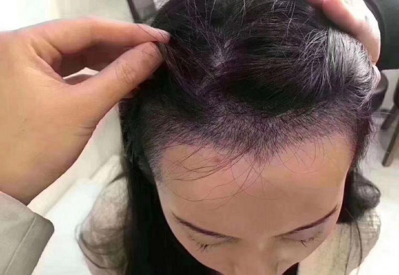 植发多少钱
