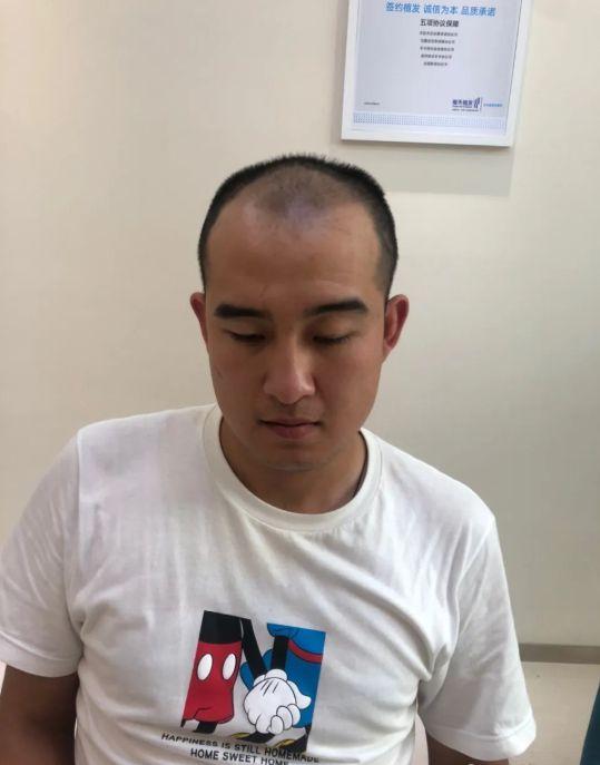 植发怎么植上去的