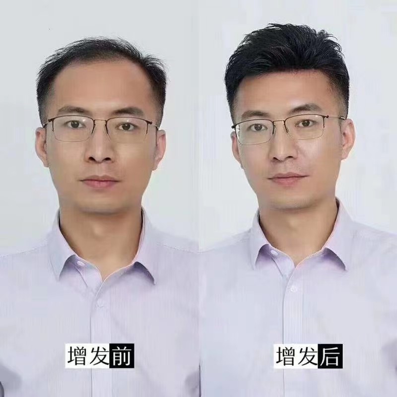 假发织发补发哪家好，什么是织发