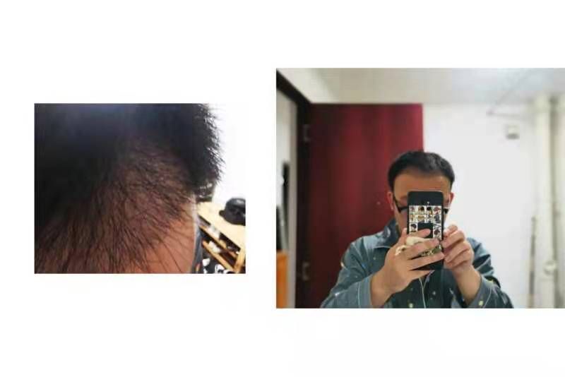 植发一般能保持多久