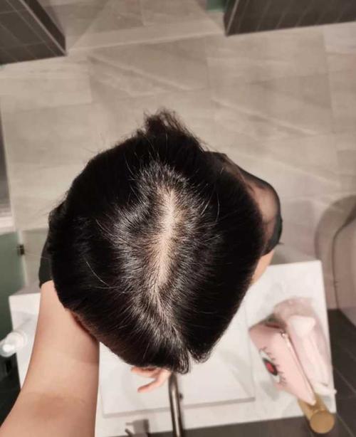 脂溢性脱发的原因是什么 溢脂性脱发该怎么办