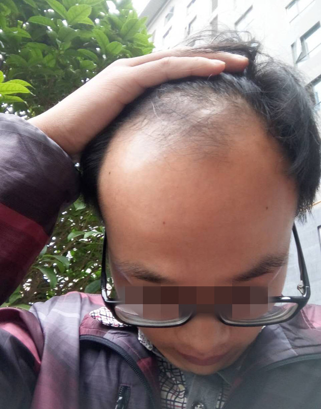 植发的效果能保持多久