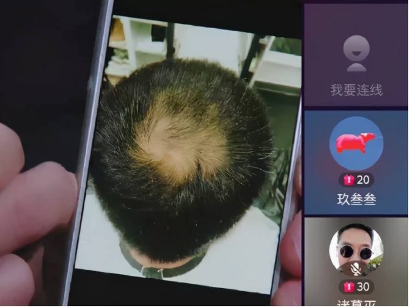 地中海脱发的原因？地中海脱发怎么治疗？