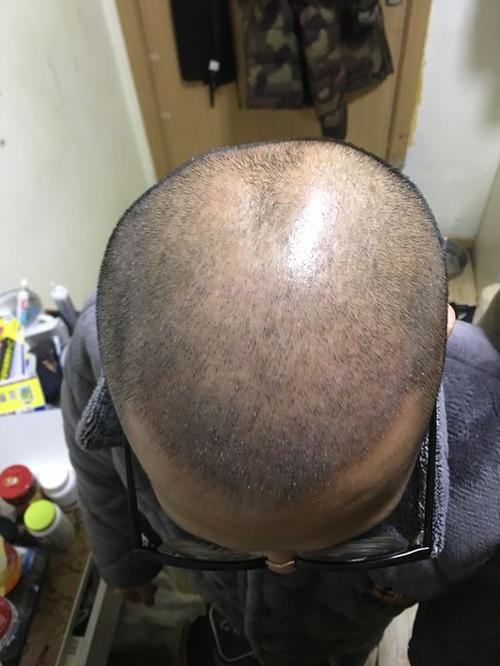 植发的原理是什么？植发费用一般多少左右？