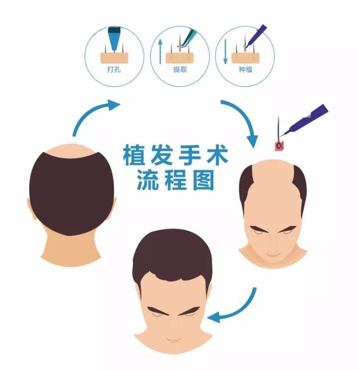 植发多久能长出新头发，植发有风险吗？