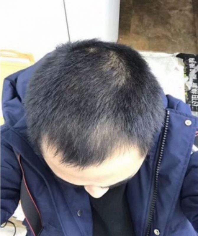 二级脱发植发多少钱？植发危害有什么危害？