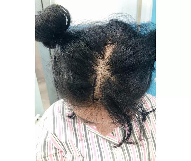 二级脱发植发多少钱？植发危害有什么危害？