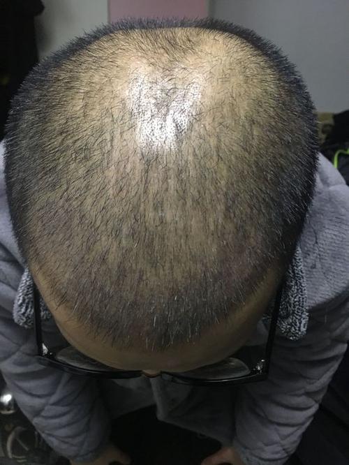 植发后三个月效果图，极客补发让你恢复青春活力