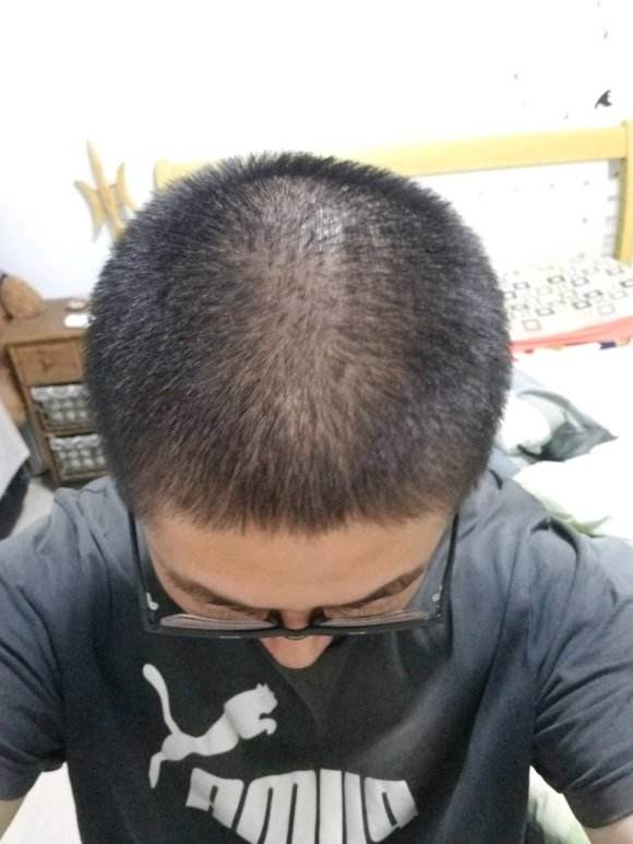 脱发是什么原因引起的中医角度 中医如何治疗脱发