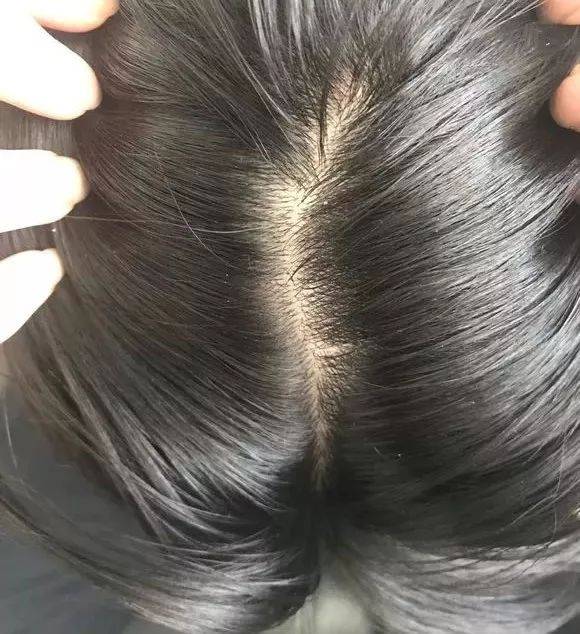 最有效的生发方法