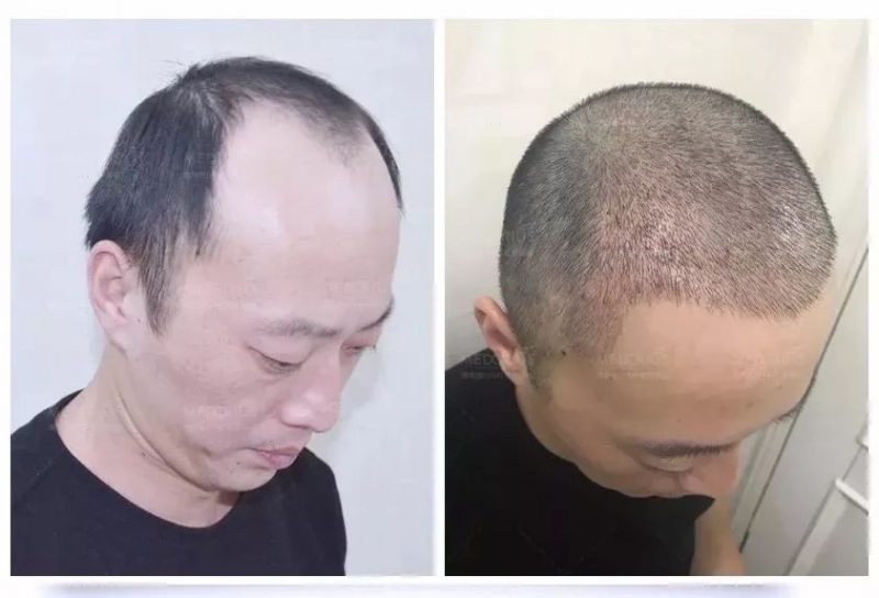 女性生发产品哪个效果好？补发怎么护理