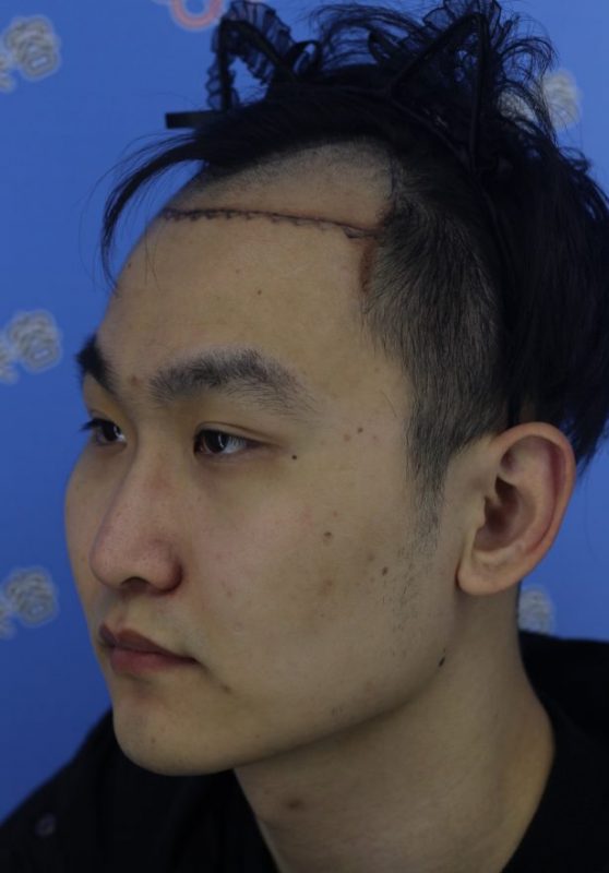 植发多长时间能和原生头发一样？极客补发和植发有什么区别？
