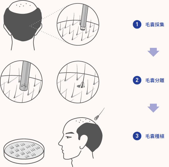 植发一般价位是多少