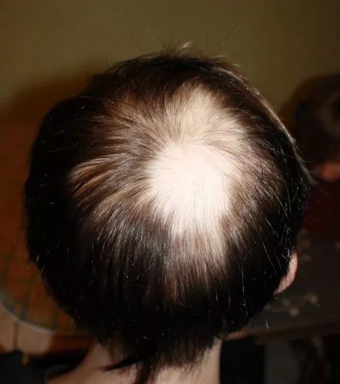 防脱发的妙招有哪些？什么原因导致的脱发？