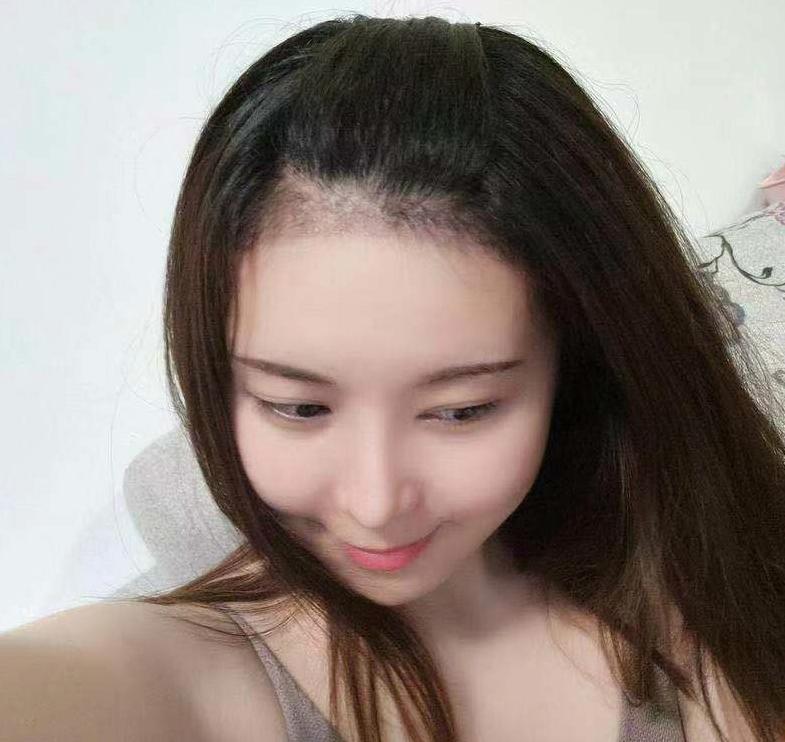 发际线补发价格是多少?优缺点分别是什么?