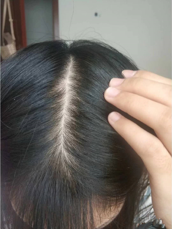 大量脱发怎么办 脱发吃什么好