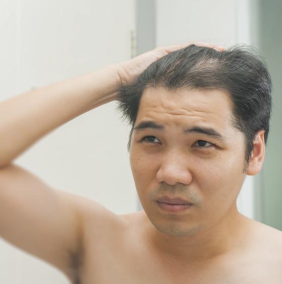 什么生发产品效果最好 治疗脱发偏方