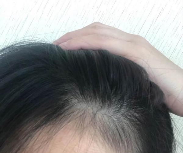 生发吃什么好？