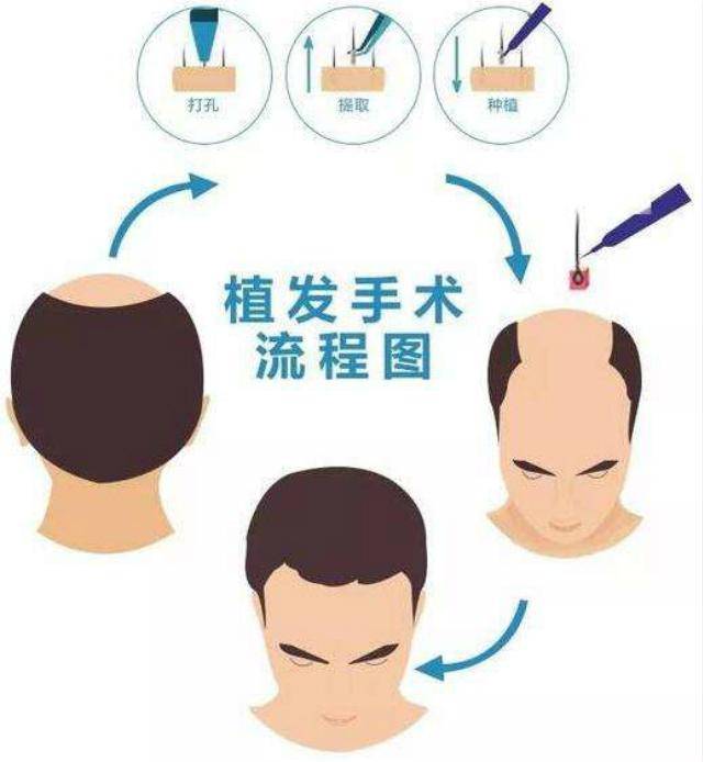 植发效果能维持多久?植发好还是补发好？