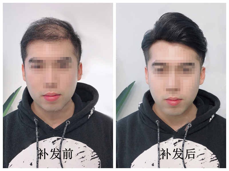 织发补发效果好吗?织发补发价格受到哪些因素影响?