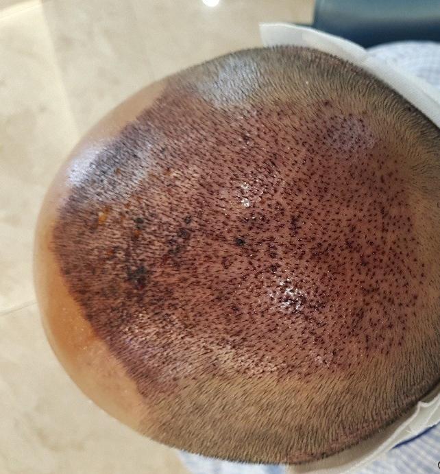 植发手术需要多少费用