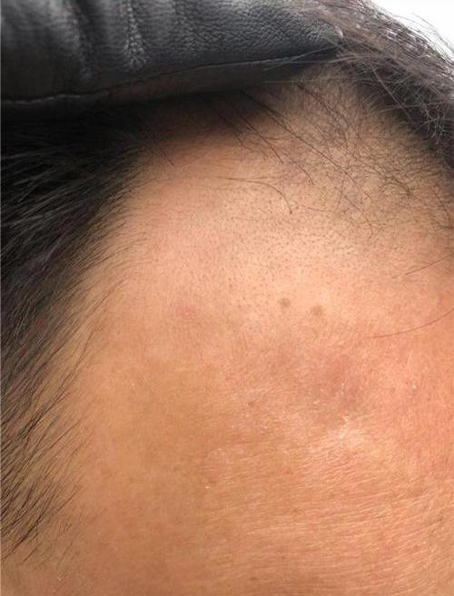 生发酊对脂溢性脱发有效吗？生发酊用多久才能长头发？