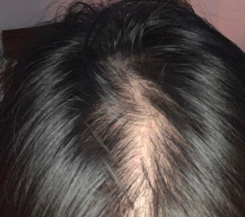 怎么生发和增发？头发稀少增发的方法有哪些？