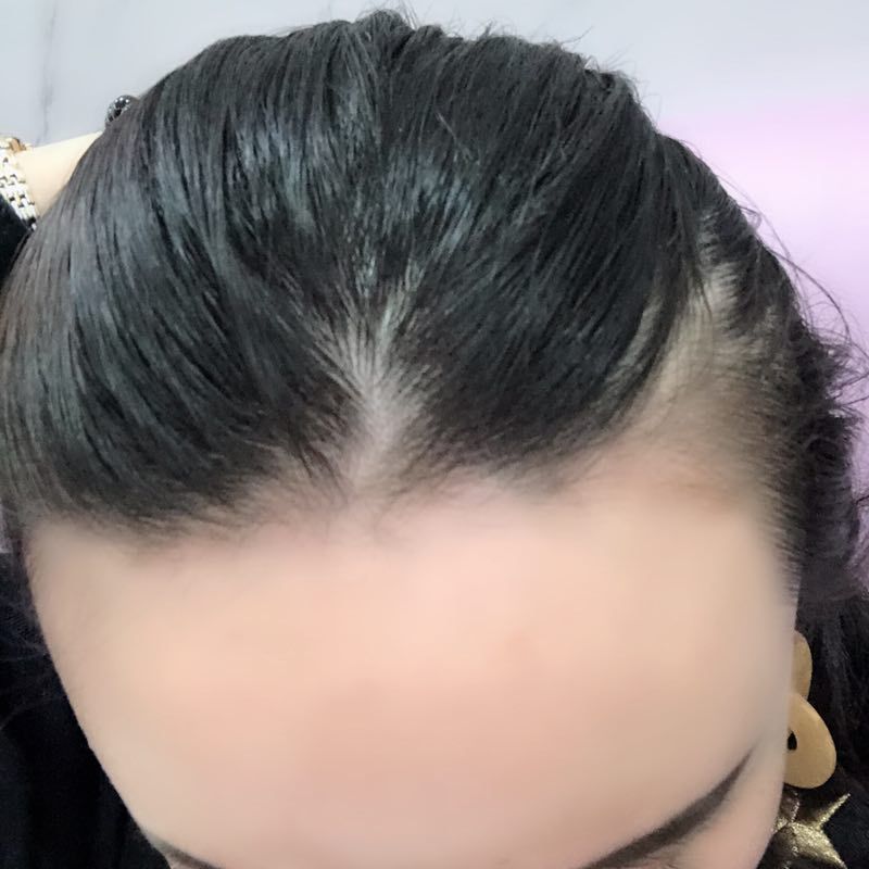 植发可以维持多久呢多少钱?植发相对于补发有什么劣势?
