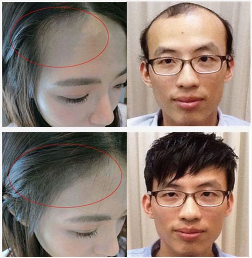 激活毛囊生发的偏方，教你如何判断毛囊的死活