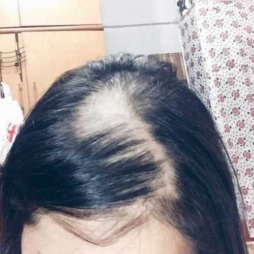 头顶脱发严重怎么办 头顶脱发怎么回事