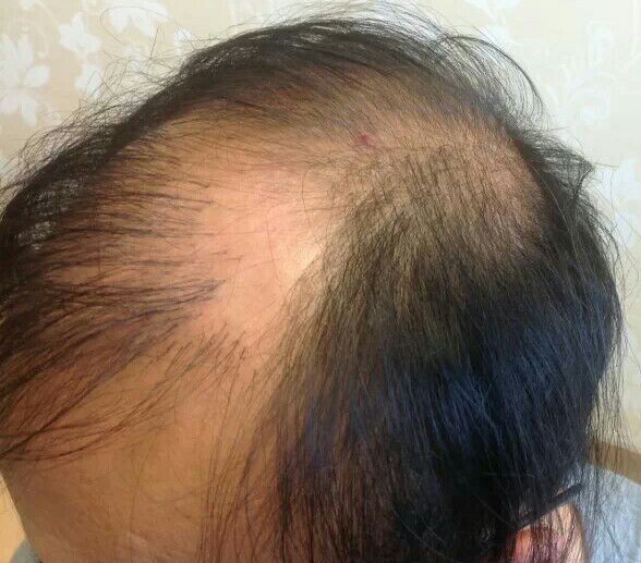 唐风采表皮植发怎么样？补发的效果好不好？