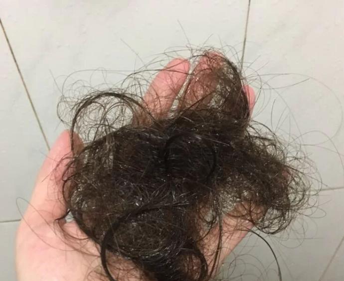 头发脱发严重怎么回事？脱发严重怎么办？