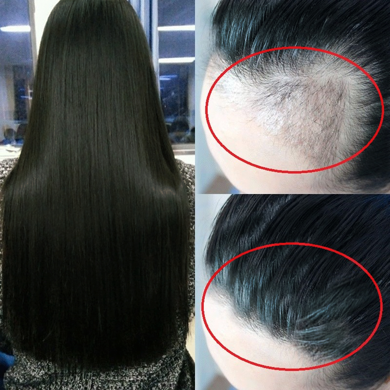 如果脱发怎么办怎么治疗再生发呢？