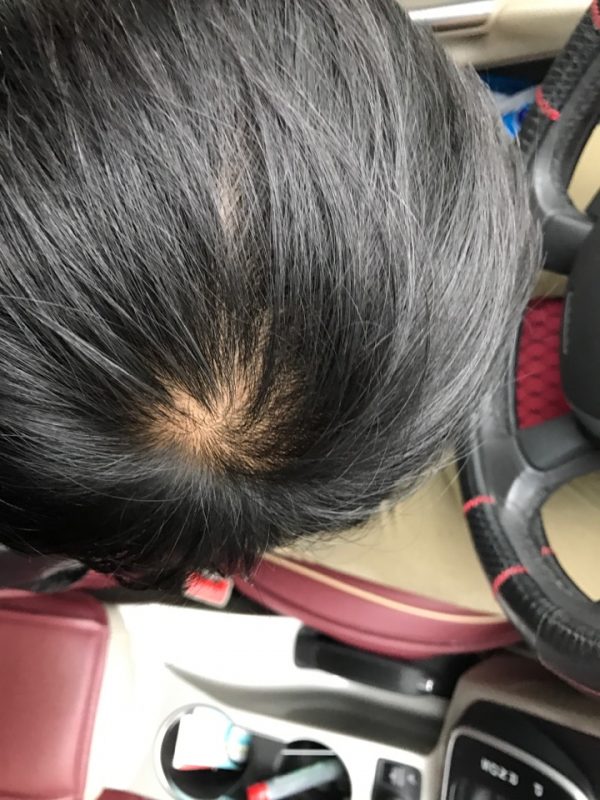 生发产品哪个效果好知乎教你选择