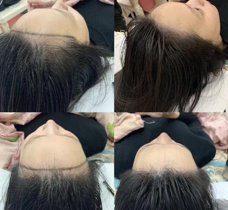 脱发后如何快速长出新头发?看看脱发的原因是什么