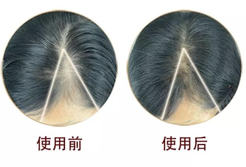 脱发后如何快速长出新头发?