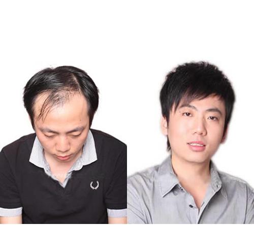 唐风采植发效果怎么样