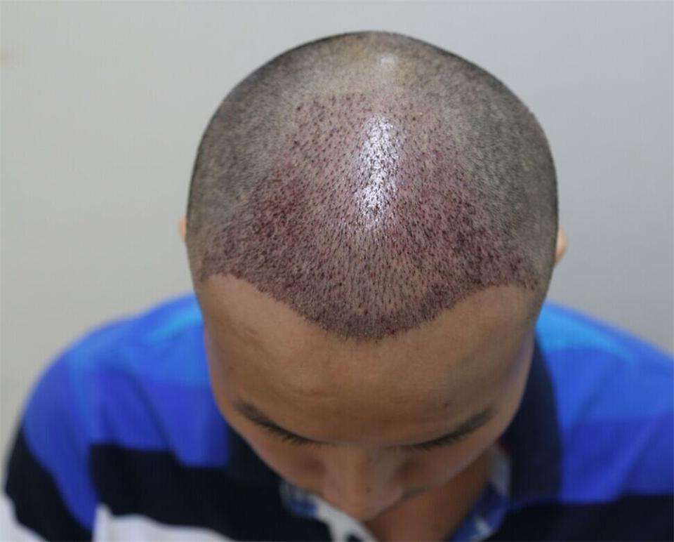 1000个毛囊植发的价格是多少?植发的劣势分别有哪些?