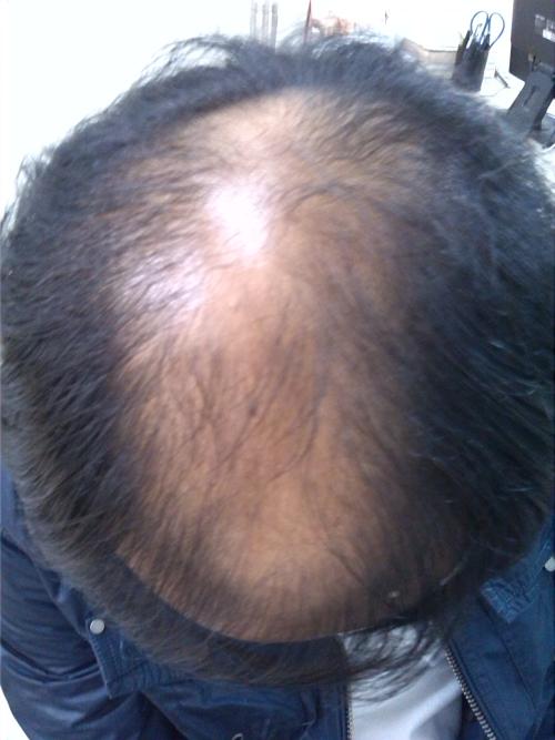 斑秃属于什么脱发？这些一定要了解