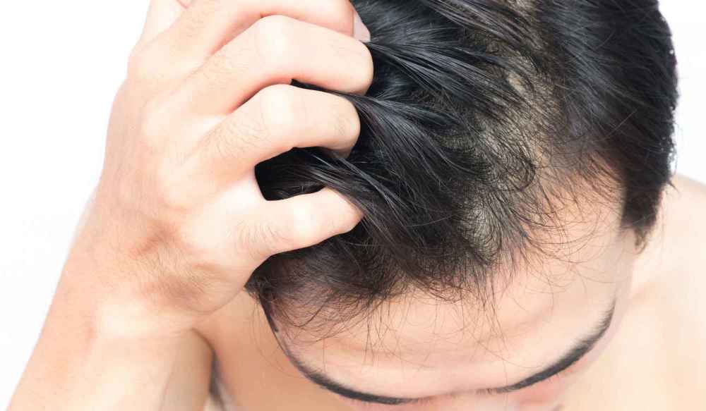 脱发类型有哪些？脱发如何治疗？