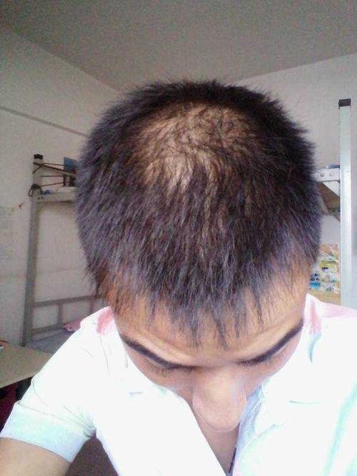 脱发是什么原因引起的男
