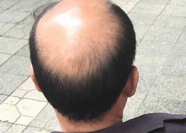究竟什么叫做肾亏型脱发？肾亏型脱发的人应该怎么治疗呢？