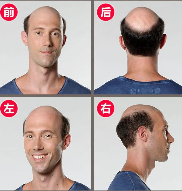 引起脱发的主要原因 脱发怎么治疗好
