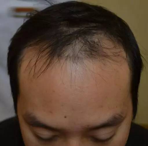 脱发是缺少什么维生素？如何预防脱发？